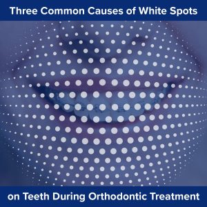 Atlanta orthodontist, Dr. Ceneviz at Chamblee Orthodontics discusses three common causes of white spots during your orthodontic treatment.