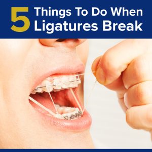 Atlanta dentist, Dr. Ceneviz at Chamblee Orthodontics shares tips on what to do when your ligatures break.