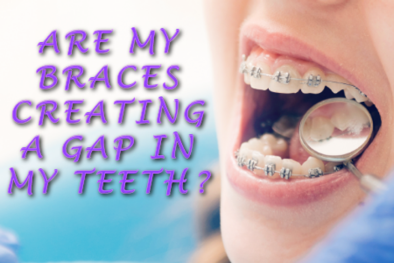 Braces Causing A Gap Chamblee Orthodontics Atlanta, GA