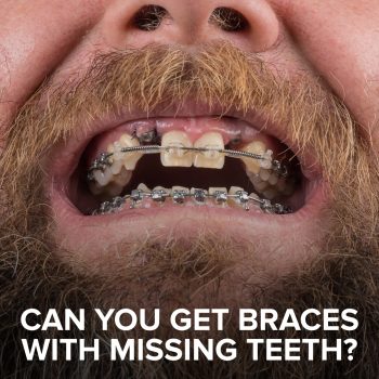 Experiencing missing teeth and malocclusions? Atlanta dentist, Dr. Ceneviz at Chamblee Orthodontics, shares how orthodontics and restorative dentistry can work together to help you achieve a complete, straight smile.