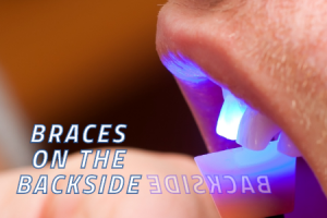 Atlanta dentist, Dr. Ceneviz at Chamblee Orthodontics explains how Lingual Braces work