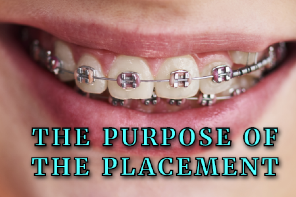 Why Braces Are Placed In Different Spots Chamblee Orthodontics Atlanta Ga 7650