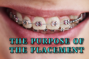 Atlanta orthodontist, Dr. Ceneviz at Chamblee Orthodontics provides insight as to why your braces are placed in different spots.