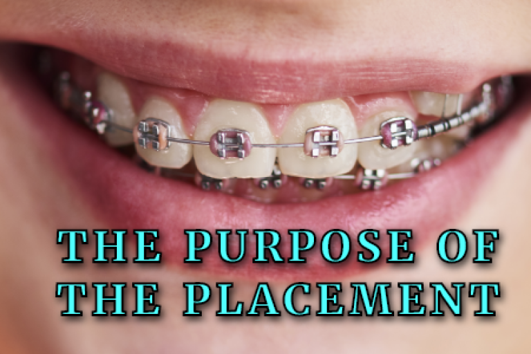 Why Braces Are Placed in Different Spots Chamblee Orthodontics