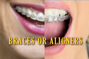 Atlanta dentist, Dr. Caroline Ceneviz at Chamblee Orthodontics explains the different applications of braces and clear aligners, and when each is most effective.
