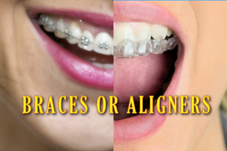 Braces v Aligners Chamblee Orthodontics Atlanta, GA