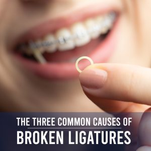 Atlanta dentist, Dr. Caroline Ceneviz at Chamblee Orthodontics discusses the three common causes of broken ligatures that you need to know to avoid.
