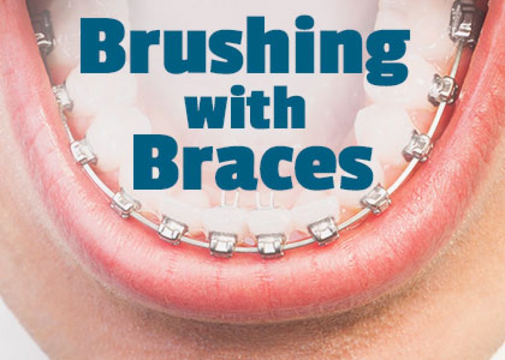 Brushing with Braces in Atlanta, GA Chamblee Orthodontics