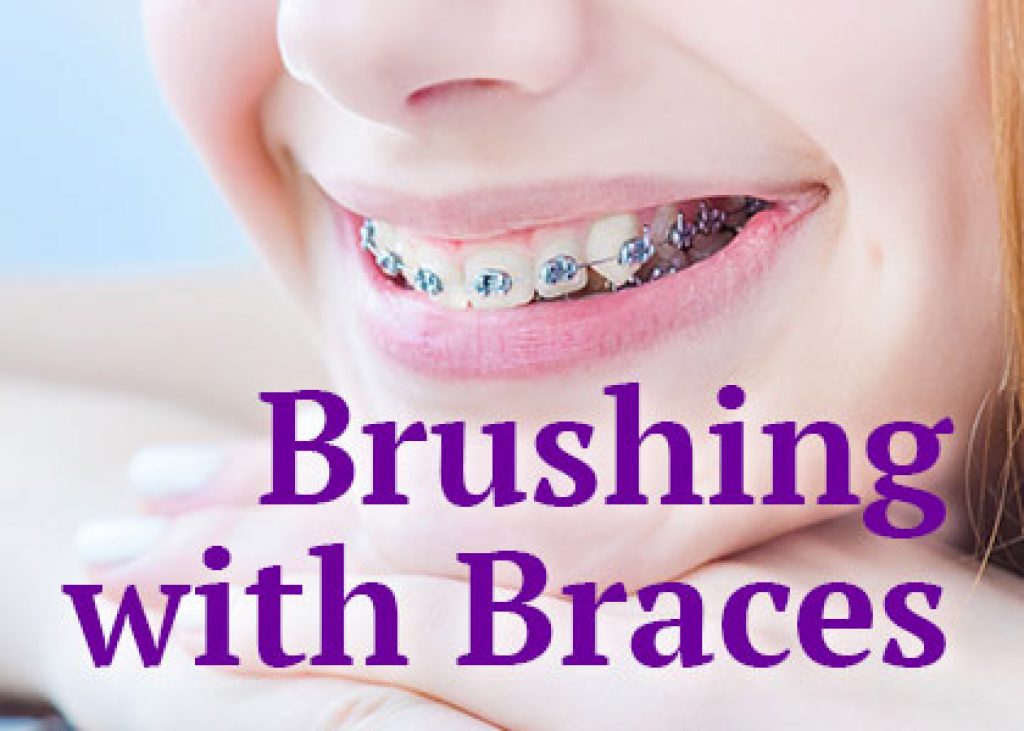 Brushing with Braces in Atlanta, GA Chamblee Orthodontics