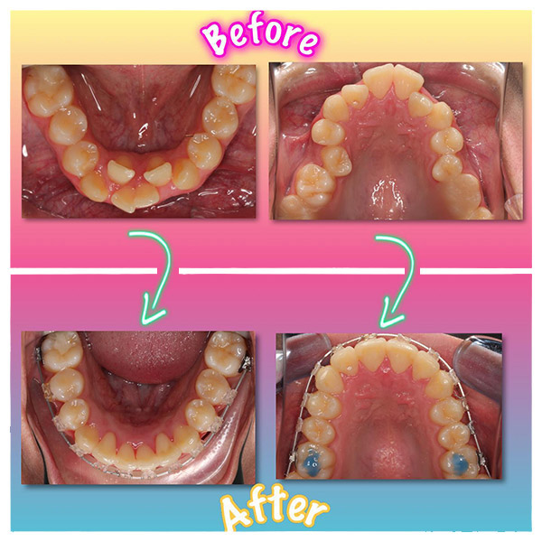 Before & After Photo