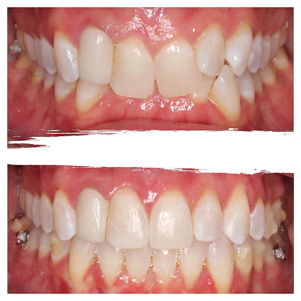 Before & After Photo