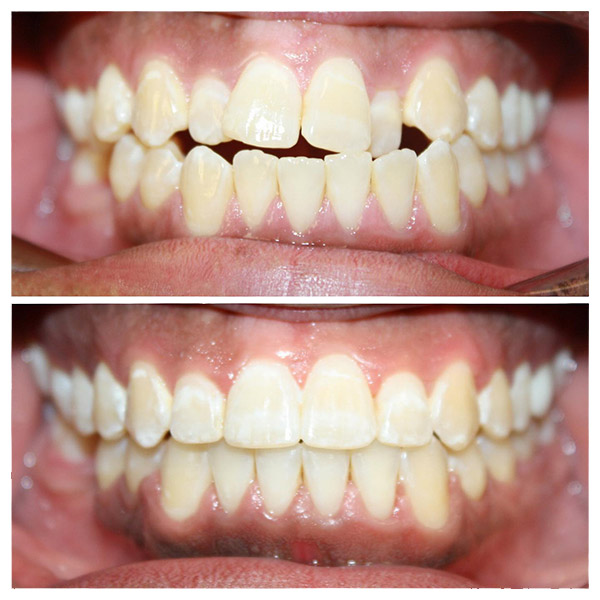 Before & After Photo
