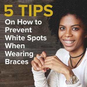 Atlanta dentist, Dr. Ceneviz at Chamblee Orthodontics shares five tips on how to prevent white spots from forming on your teeth during your orthodontic treatment with braces.