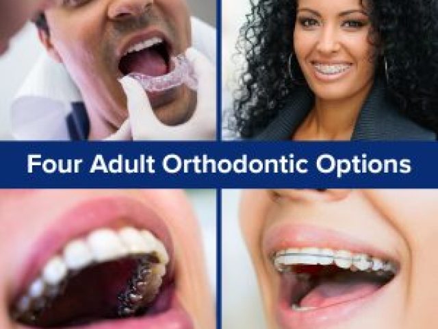 Four Adult Orthodontic Options (featured image)