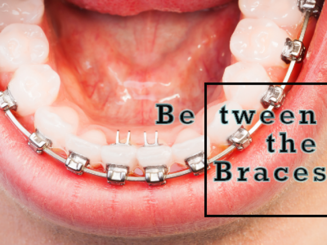 Between the Braces (featured image)