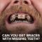 Can You Get Braces with Missing Teeth? Here’s What You Should Know – Charting a Path to a Healthier Smile (featured image)