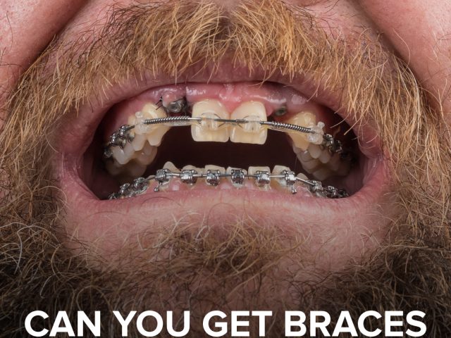 Can You Get Braces with Missing Teeth? Here’s What You Should Know – Charting a Path to a Healthier Smile (featured image)