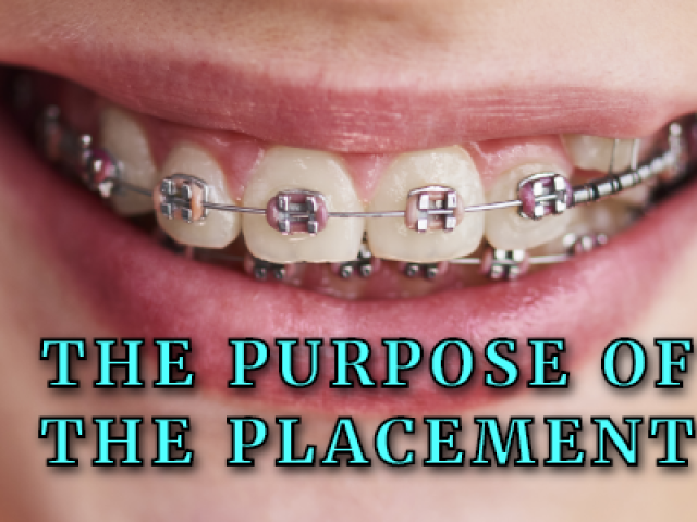 Why are my braces positioned at different spots on my teeth? (featured image)