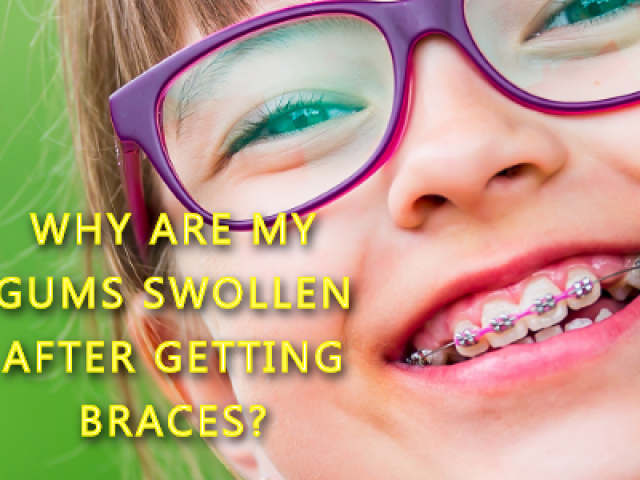 Why Are My Gums Swollen After Getting Braces? (featured image)