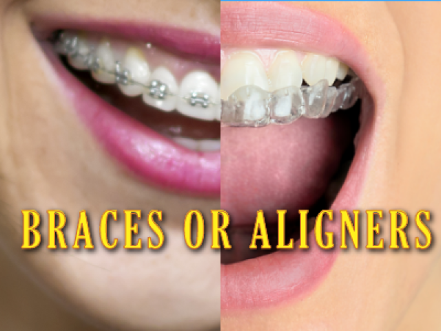 Braces or Aligners, Which Is Right For Me? (featured image)