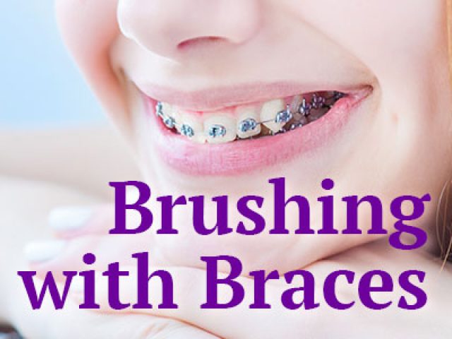 Brushing with Braces: Cleaning Every Nook & Cranny (featured image)