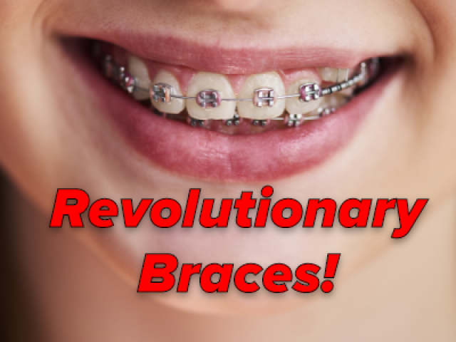 Damon Braces: A More Comfortable Way To Straighten Your Teeth. (featured image)