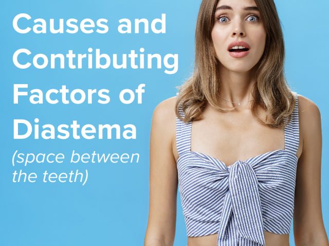 What is Diastema, and What Causes It? (featured image)