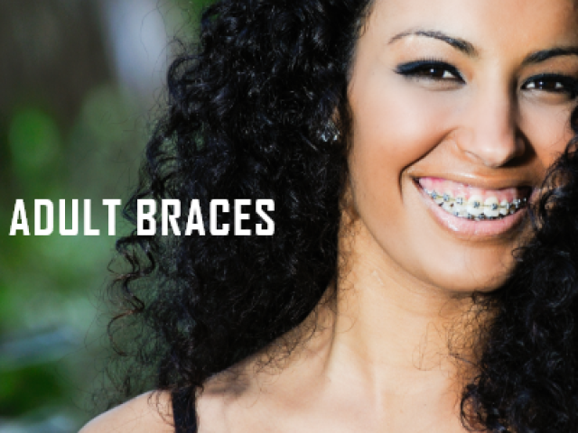 A Few Quick Tips to Help You Find the Best Adult Braces (featured image)