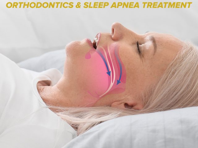 The Connection Between Orthodontics and Sleep Apnea Treatment (featured image)