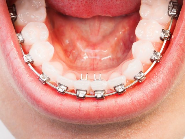 The Final Countdown… to Orthodontic Treatment (featured image)