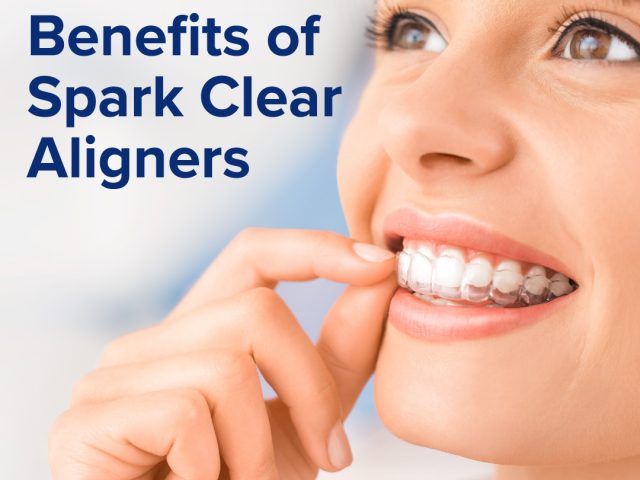 The Five Benefits Of Clear Aligners (featured image)