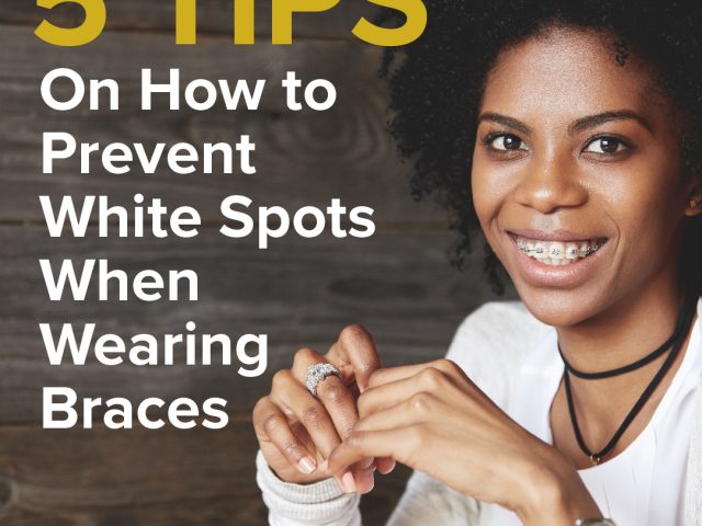 Five Tips On How To Prevent White Spots When Wearing Braces (featured image)